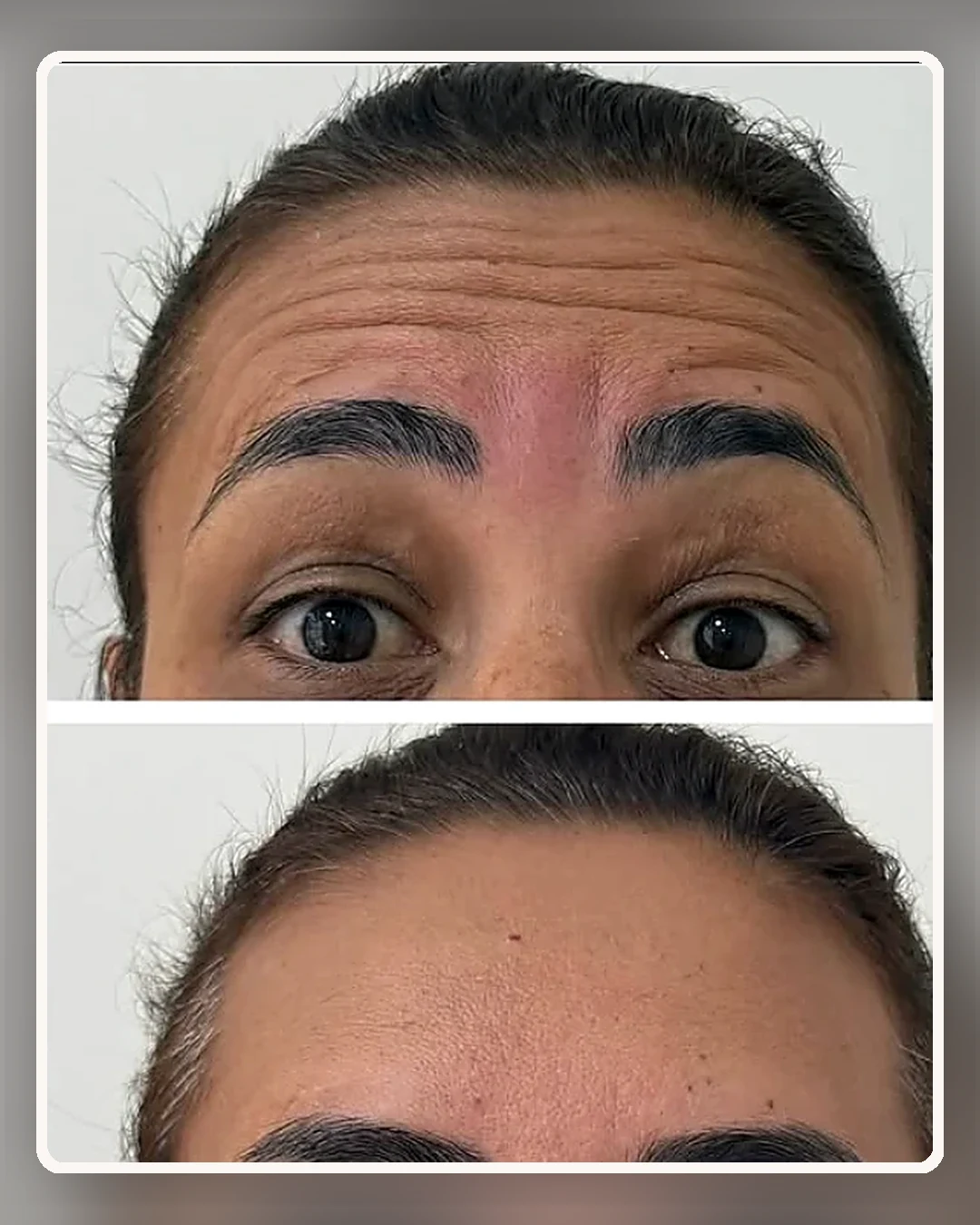 Comparativo de tratamento facial na região da testa