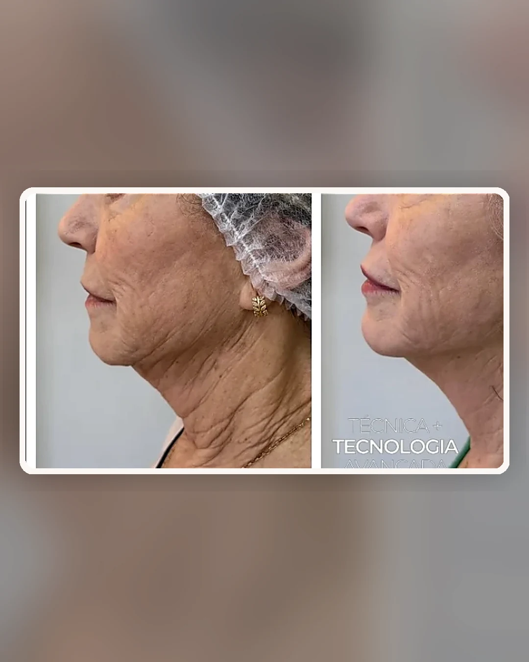 Comparativo de rejuvenescimento facial em perfil