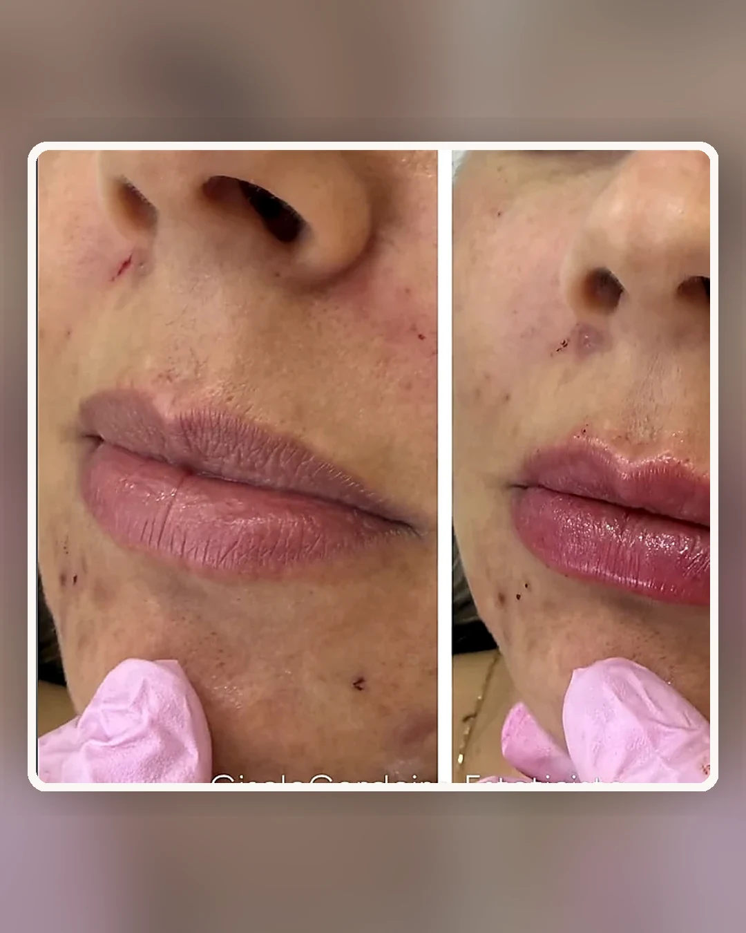 Comparativo de preenchimento labial