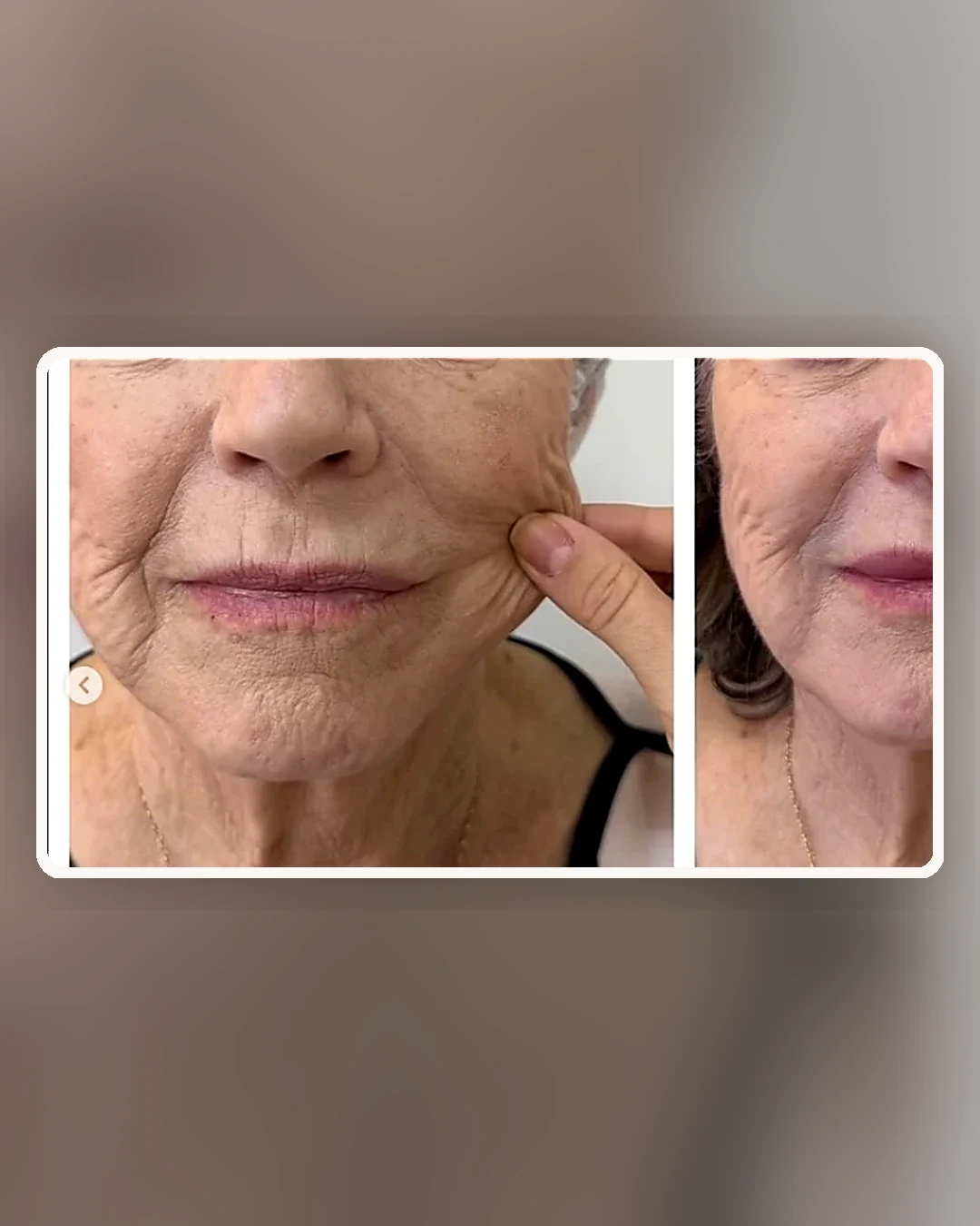 Comparativo frontal de rejuvenescimento facial